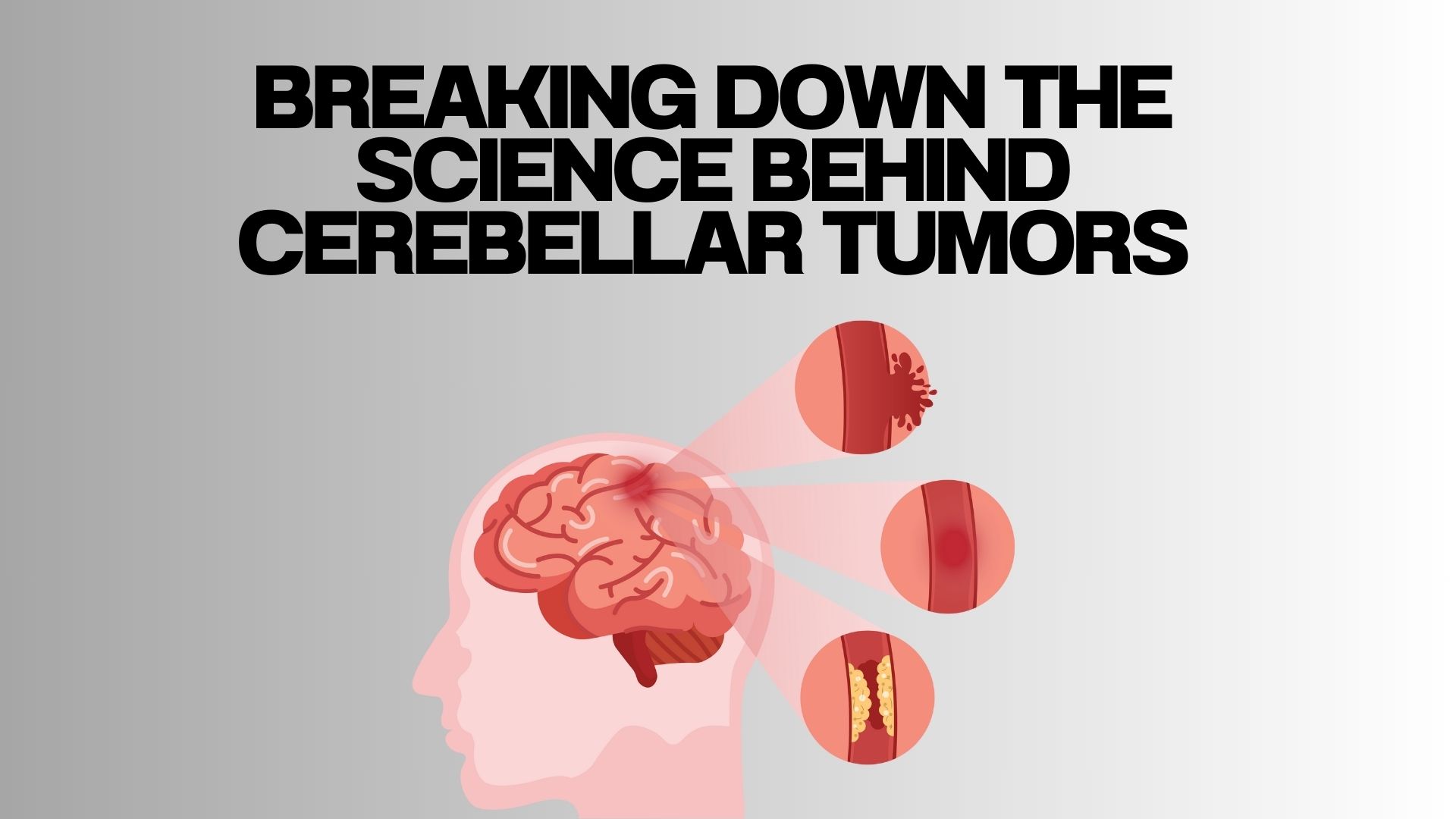 Breaking down the science behind cerebellar tumors
